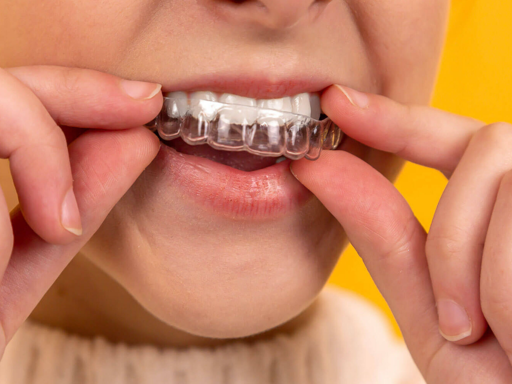 person putting on clear dental aligners