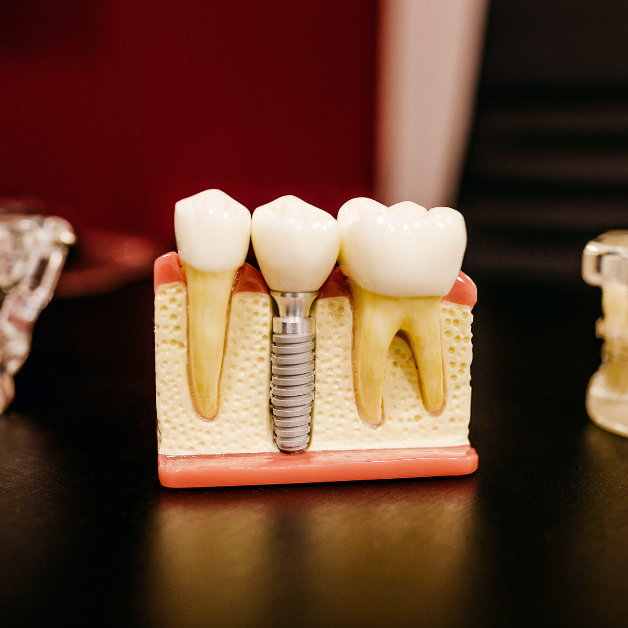 model of dental implants